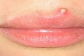 Understanding and Treating pimple on lip