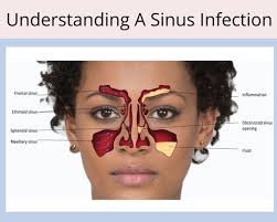 Isa Sinus Infection Contagious? Best Understanding the Risks and Prevention in 2024