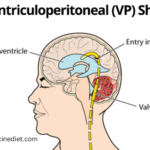 vp shunt