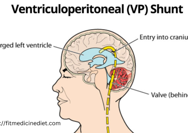 VP Shunt: An Overview of  the best information 2024 Ventriculoperitoneal Shunt Surgery and Its Applications