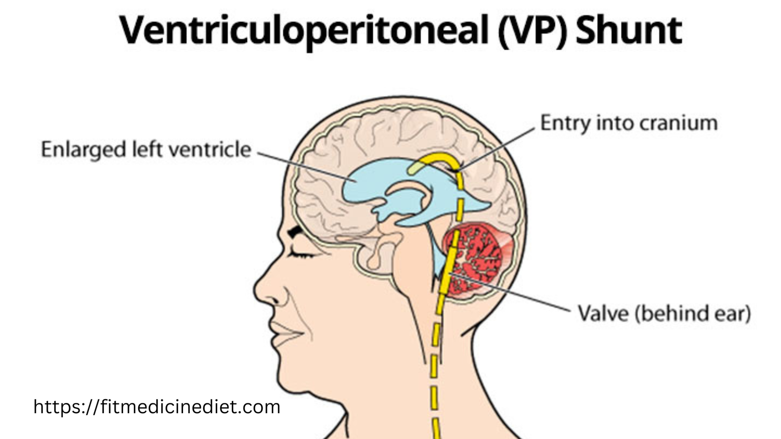 VP Shunt: An Overview of  the best information 2024 Ventriculoperitoneal Shunt Surgery and Its Applications