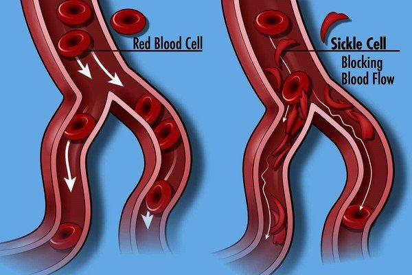 Sick of Cell: Understanding the Impact of Sickle Cell Disease and the Quest for a Cure best 2024